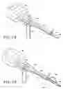Fig. 02 - Suction sleeve and interventional devices having such a suction sleeve