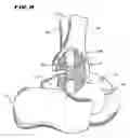 Fig. 07 - Intramedullary guidance systems and methods for installing ankle replacement prostheses