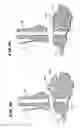 Fig. 09 - Intramedullary guidance systems and methods for installing ankle replacement prostheses