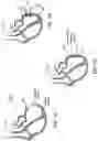 Fig. 02 - Hemostatic patch for treating congestive heart failure
