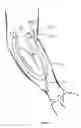 Fig. 09 - Percutaneous mechanical fragmentation catheter system
