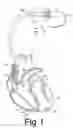 Fig. 02 - Methods for ventricular pacing
