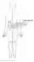 Fig. 01 - Device and method for electrically inducing osteogenesis in the spine