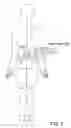 Fig. 04 - Device and method for electrically inducing osteogenesis in the spine