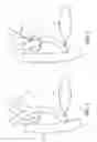 Fig. 02 - Biliary stent introducer system