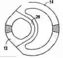 Fig. 01 - Peritoneal dialysis catheter