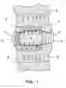 Fig. 02 - System and method for the pretreatment of the endplates of an intervertebral disc