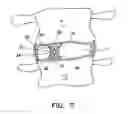 Fig. 06 - System and method for the pretreatment of the endplates of an intervertebral disc