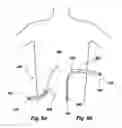 Fig. 07 - Apparatus and method for peritoneal dialysis