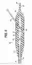 Fig. 04 - Method for implanting flexible injection port