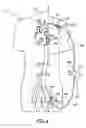 Fig. 07 - Cannulae for selectively enhancing blood flow
