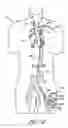 Fig. 11 - Cannulae for selectively enhancing blood flow