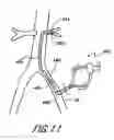 Fig. 12 - Cannulae for selectively enhancing blood flow
