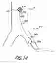 Fig. 15 - Cannulae for selectively enhancing blood flow