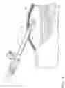 Fig. 07 - Method and device for minimally invasive implantation of biomaterial