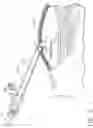 Fig. 09 - Method and device for minimally invasive implantation of biomaterial
