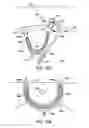 Fig. 75 - Systems, methods and devices relating to delivery of medical implants