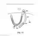 Fig. 76 - Systems, methods and devices relating to delivery of medical implants
