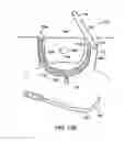Fig. 80 - Systems, methods and devices relating to delivery of medical implants