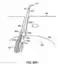 Fig. 81 - Systems, methods and devices relating to delivery of medical implants