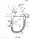 Fig. 71 - Systems, methods and devices relating to delivery of medical implants