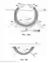Fig. 72 - Systems, methods and devices relating to delivery of medical implants