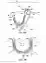 Fig. 75 - Systems, methods and devices relating to delivery of medical implants