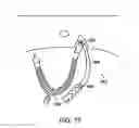 Fig. 76 - Systems, methods and devices relating to delivery of medical implants