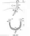Fig. 77 - Systems, methods and devices relating to delivery of medical implants