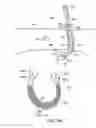Fig. 69 - Systems, methods and devices relating to delivery of medical implants