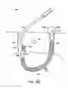 Fig. 70 - Systems, methods and devices relating to delivery of medical implants