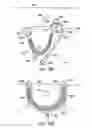 Fig. 75 - Systems, methods and devices relating to delivery of medical implants