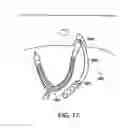 Fig. 76 - Systems, methods and devices relating to delivery of medical implants