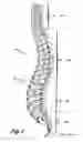 Fig. 02 - Polyaxial adjustment of facet joint prostheses