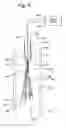 Fig. 08 - Recoilable thrombosis filtering device and method