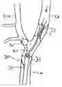 Fig. 01 - Apparatus and methods for reducing embolization during treatment of carotid artery disease