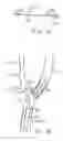 Fig. 06 - Apparatus and methods for reducing embolization during treatment of carotid artery disease