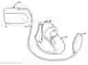 Fig. 01 - Apparatus for detecting and treating ventricular arrhythmia