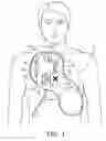Fig. 02 - Integrated resuscitation