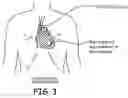 Fig. 04 - Precordial-superior vena cava electrode arrangement for an implantable cardioverter defibrillator