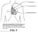 Fig. 06 - Precordial-superior vena cava electrode arrangement for an implantable cardioverter defibrillator