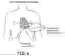 Fig. 07 - Precordial-superior vena cava electrode arrangement for an implantable cardioverter defibrillator