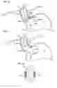 Fig. 07 - High frequency vagal blockage therapy