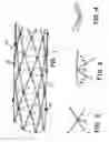 Fig. 02 - Intraluminal stent and graft