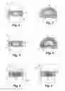 Fig. 02 - Intervertebral disc nucleus implants and methods