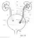 Fig. 02 - Ureteral stent