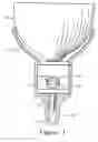 Fig. 02 - Prosthetic locking device
