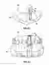 Fig. 06 - Implant positioning device and method