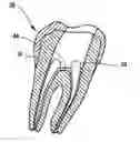 Fig. 01 - Methods of filling a root canal with adhesive endodontic cones and polymerizable filling and sealing materials