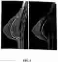 Fig. 02 - Breast support apparatus